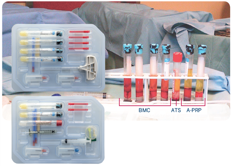 prp treatment . Platelet rich plasma treatment . cell therapy regenlab. plasma treatment cellular matrix